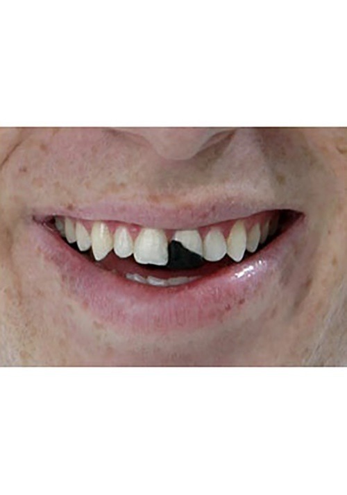 Missing Tooth Cosmetic Wax